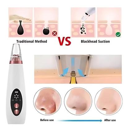 Imagem de Tira Cravos e Espinhas com Aparelho de Sucção a Vácuo