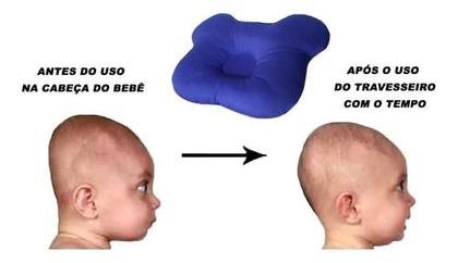Imagem de Travesseiro Plagiocefalia Para Bebe Com Cabeça Chata