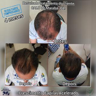 Calvície e queda de cabelo