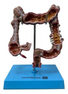 Intestino Humano Grosso Colon Ascendente Descendente E Reto
