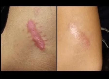 Imagem de 3 Rolos de Fita Cirúrgica De Silicone Adesiva 2,5cm x 1,5m  (Cicatriz e Queloide)- Vital Derme