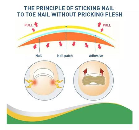 Imagem de Adesivos corretores de unhas encravadas, 100 unidades à prova d'água