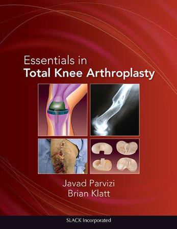 Imagem de Essentials in total knee arthroplasty - Slack Incorporated