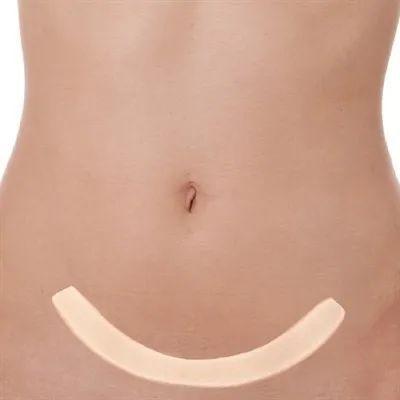 Imagem de Fita Para Cicatrizes Côncava Abdominoplastia 70x3cm Cesárea