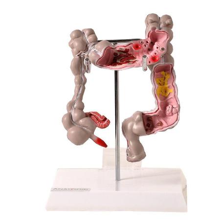 Imagem de Intestino Grosso Humano Com Patologia, Anatomia