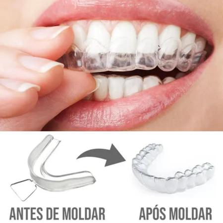 Placa para bruxismo defeituosa pode trazer problemas além dos dentes.