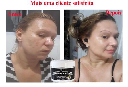 O retinol é um ativo poderoso na prevenção e tratamento dos sinais