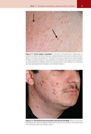 Imagem de Livro - Dermatologia de Fitzpatrick