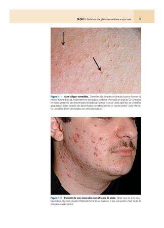 Imagem de Livro - Dermatologia de Fitzpatrick