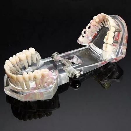 Imagem de Manequim Modelo Dentário Ortodontia Dente Implante