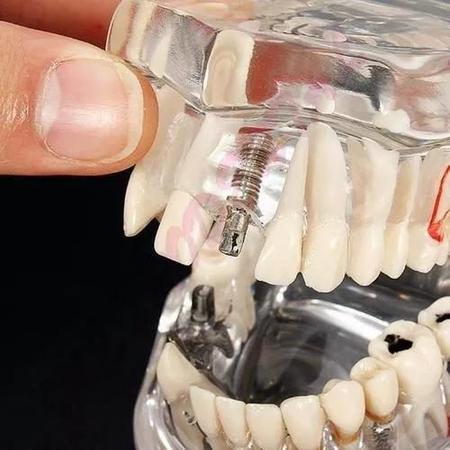 Imagem de Manequim Modelo Dentário Ortodontia Dente Implante