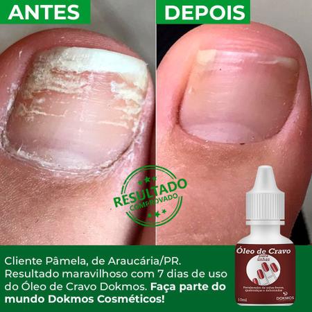 Óleo para Unha Concentrado de Cravo e Melaleuca 8ml Nail Queen -  Coprobel-Mobile