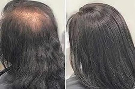 Prótese Capilar Disfarça Calvície Falhas do Couro Cabeludo Cabelo