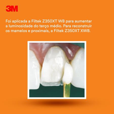 Imagem de Resina Composta Restauração Odontologia Z350 XT cor A1B 3M