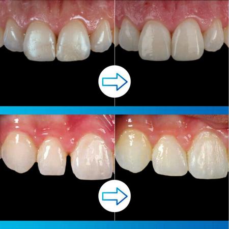 Imagem de Resina Composta Restauração Odontologia Z350 XT cor B1B 3M