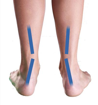 tênis com pisada supinada