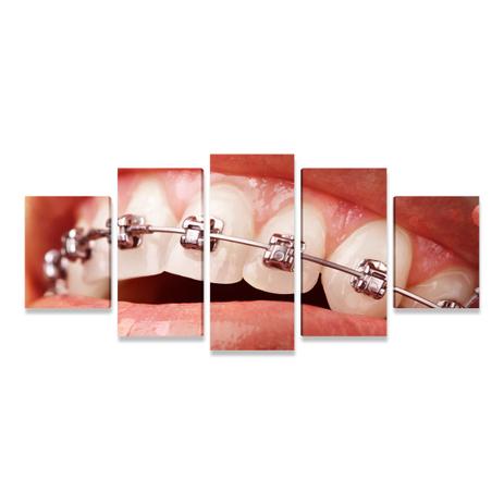 Quadro Odontologia Ortodontia Sorriso Aparelho 5 Telas PEQ - Bimper Menor preço em Quadro Odontologia Ortodontia Sorriso Aparelho 5 Telas PEQ - Bimper