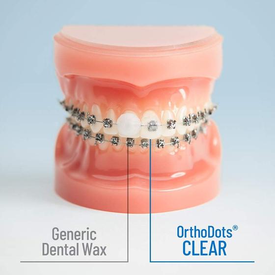 Alternativa de cera OrthoDots CLEAR Braces para alívio da dor - ORVANCE
