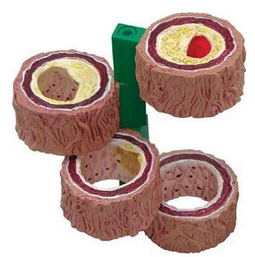 Imagem de Artéria Com Arteriosclerose Em 4 Estágios
