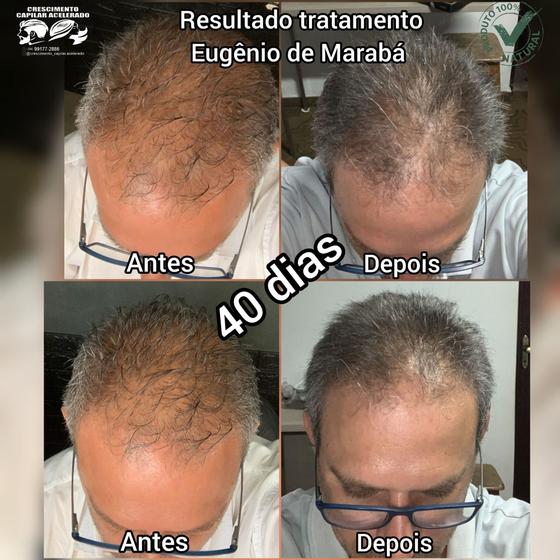 Imagem de Calvície e queda de cabelo 