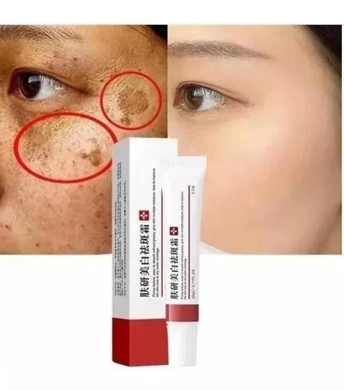 Imagem de Creme Pomada Para Tirar Manchas, Espinhas Melasma 20g