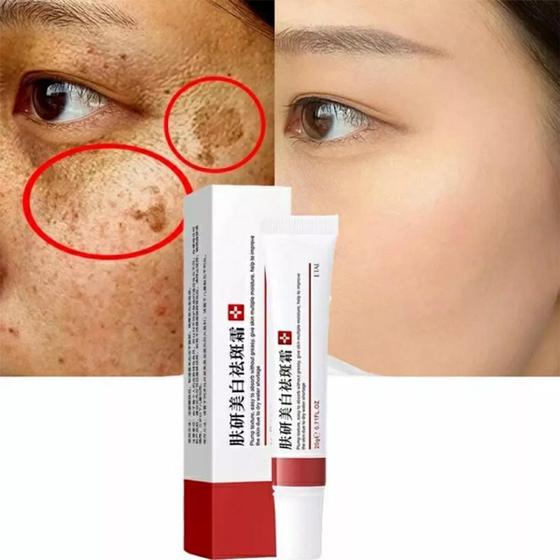 Creme Pomada Para Tirar Manchas, Espinhas Melasma eb - Ebug - Pomada ...
