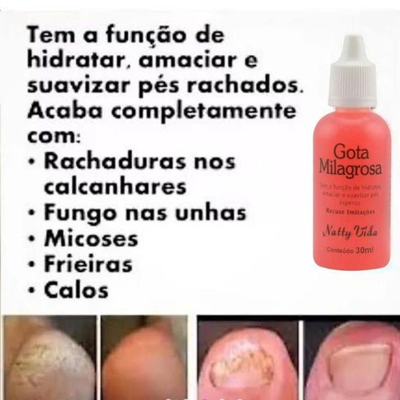 Gota Milagrosa Loção - 30Ml Rachaduras Dos Pés E Mãos Menor preço em Gota Milagrosa Loção - 30Ml Rachaduras Dos Pés E Mãos