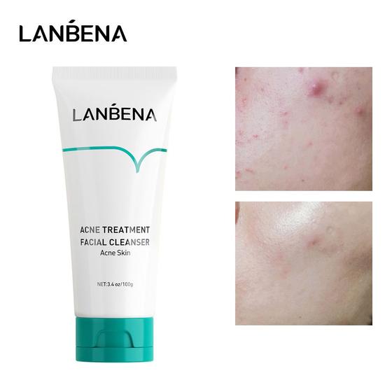 Imagem de Leite de limpeza de acne oligopeptídeo LANBENA