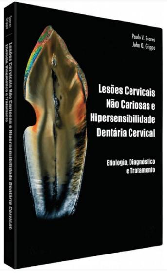 Imagem de Lesoes Cervicais Nao Cariosas E Hipersensibilidade Dentinaria Cervical - QUINTESSENCE