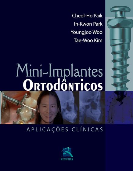 Imagem de Livro - Mini-Implantes Ortodônticos