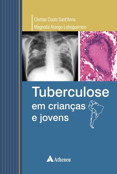 Imagem de Livro - Tuberculose em crianças e jovens