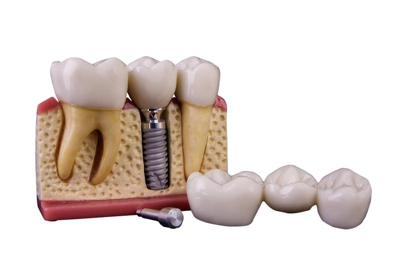 Imagem de Macro modelo manequim odontológico com implante e prótese