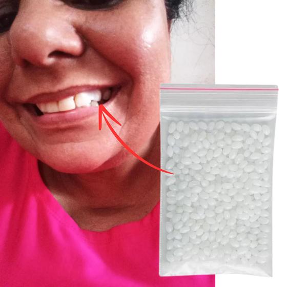 Imagem de Massa Restauração Dente Preenche Buraco Provisório