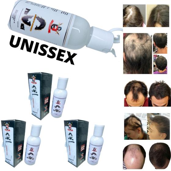 Minoxidil-Heitor Para Cabelo e Barba (Diversos Kits) Menor preço em Minoxidil-Heitor Para Cabelo e Barba (Diversos Kits)