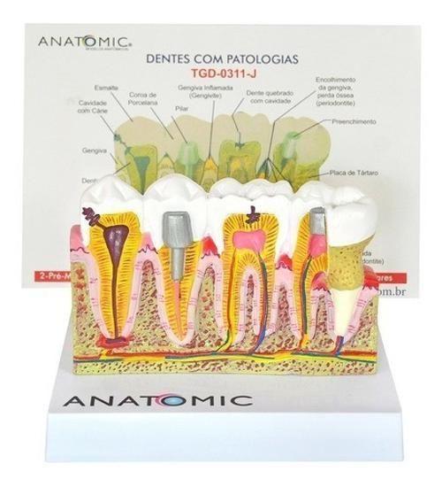 Imagem de Patologia Dentária E Placa Explicativa Em 2 Partes, Anatomia