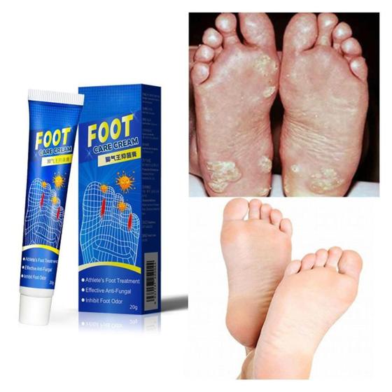 Imagem de Pomada Antifúngica para Pés Foot Cream Sumifun