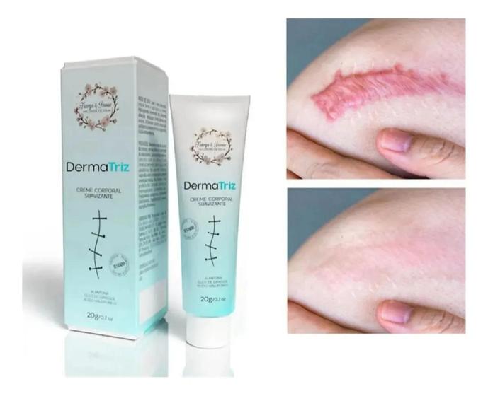 Pomada Creme DermaTriz Para Cicatriz E Estrias 20g DermaTriz. - Tiarga ...