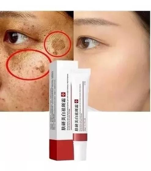 Pomada Creme Removedor Clareado Melasma, Manchas Sardas - Ebug - Creme ...