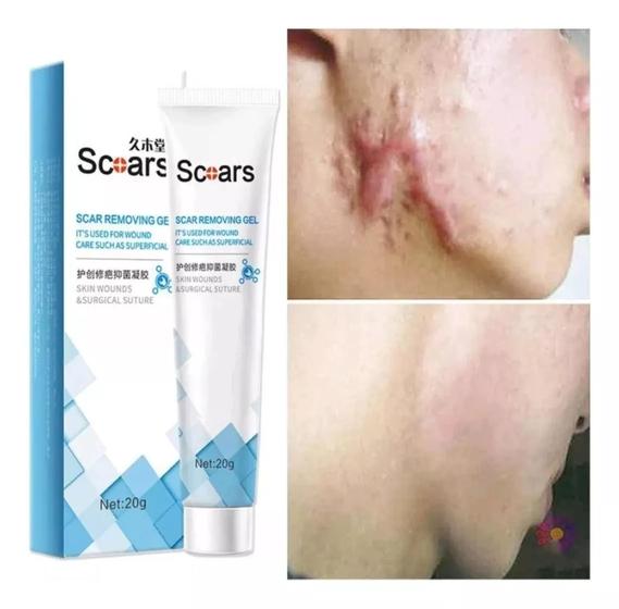 Imagem de Pomada Gel Tira Remove Cicatriz Queloide Scoars 20g.