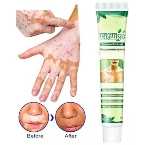 Imagem de Pomada Tratamento Vitiligo Sumifun