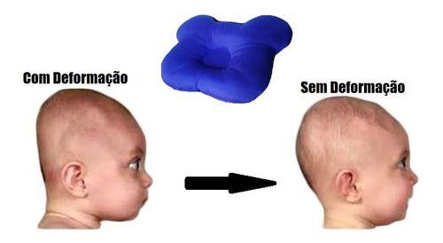 Imagem de Travesseiro Plagiocefalia Cabeça Amassada Do Bebê