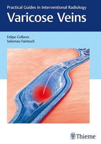 Imagem de Varicose veins: practical guides in interventional radiology