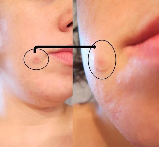 Imagem de Adesivo Hidrocoloide Acnes E Espinhas Cremer Curativo 10 UN