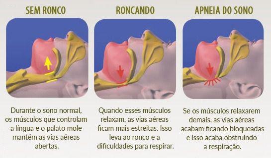 Imagem de Aparelho Bucal Moldável Anti Ronco Apneia e Ranger dos Dentes