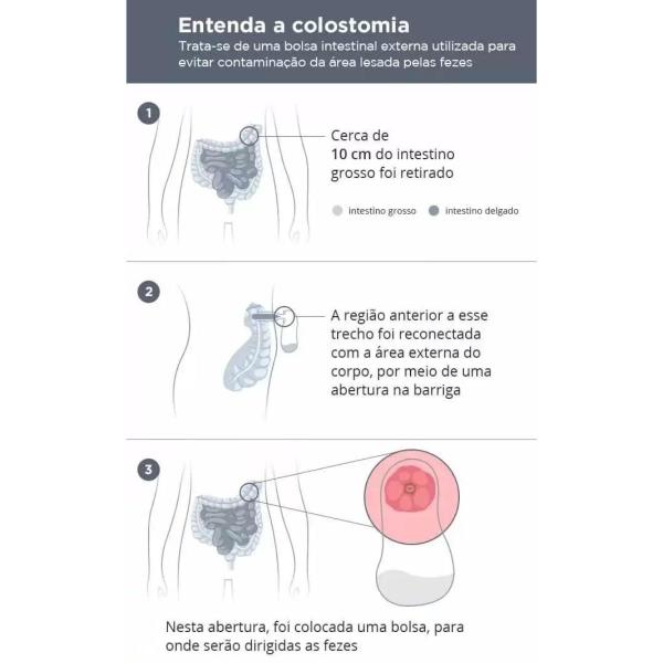 Imagem de Bolsa Colostomia Sensura Mio Drenavel Cinza 70mm 11456 1 Unidade Coloplast 