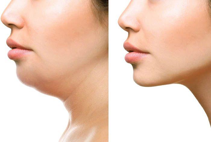 Imagem de Cinta Faixa Facial Pós Bichectomia - M02