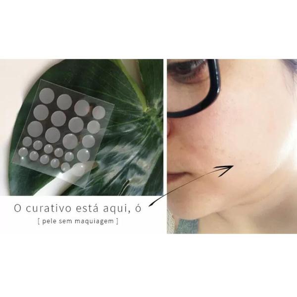 Imagem de Curativo Adesivo Hidrocoloide De Rosto Pele Aneica Acnes Anti Espinhas Seca Pele - Caixa C/24 Unidades