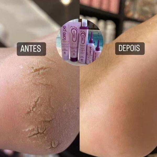Kit Lore Pé: Pés Suaves E Sem Calos - Kit Lorepé Completo Imagem de Kit Lore Pé: Pés Suaves E Sem Calos