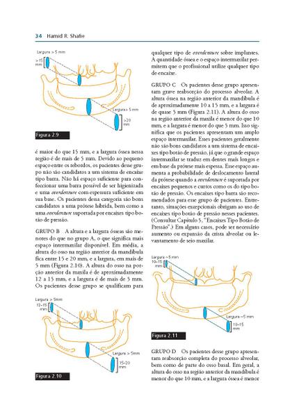 Imagem de Livro - Overdentures Sobre Implantes