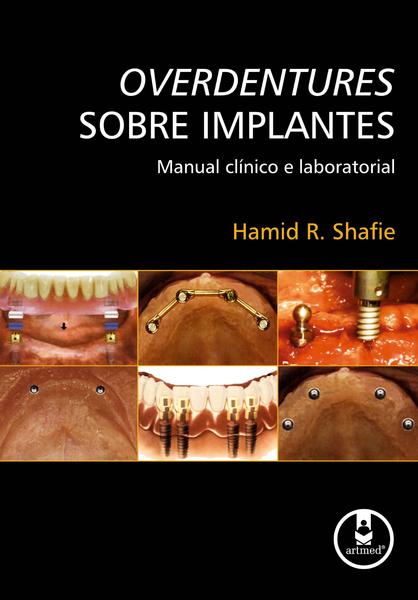 Imagem de Livro - Overdentures Sobre Implantes